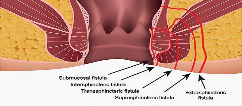 1582279994-Fistula.jpg